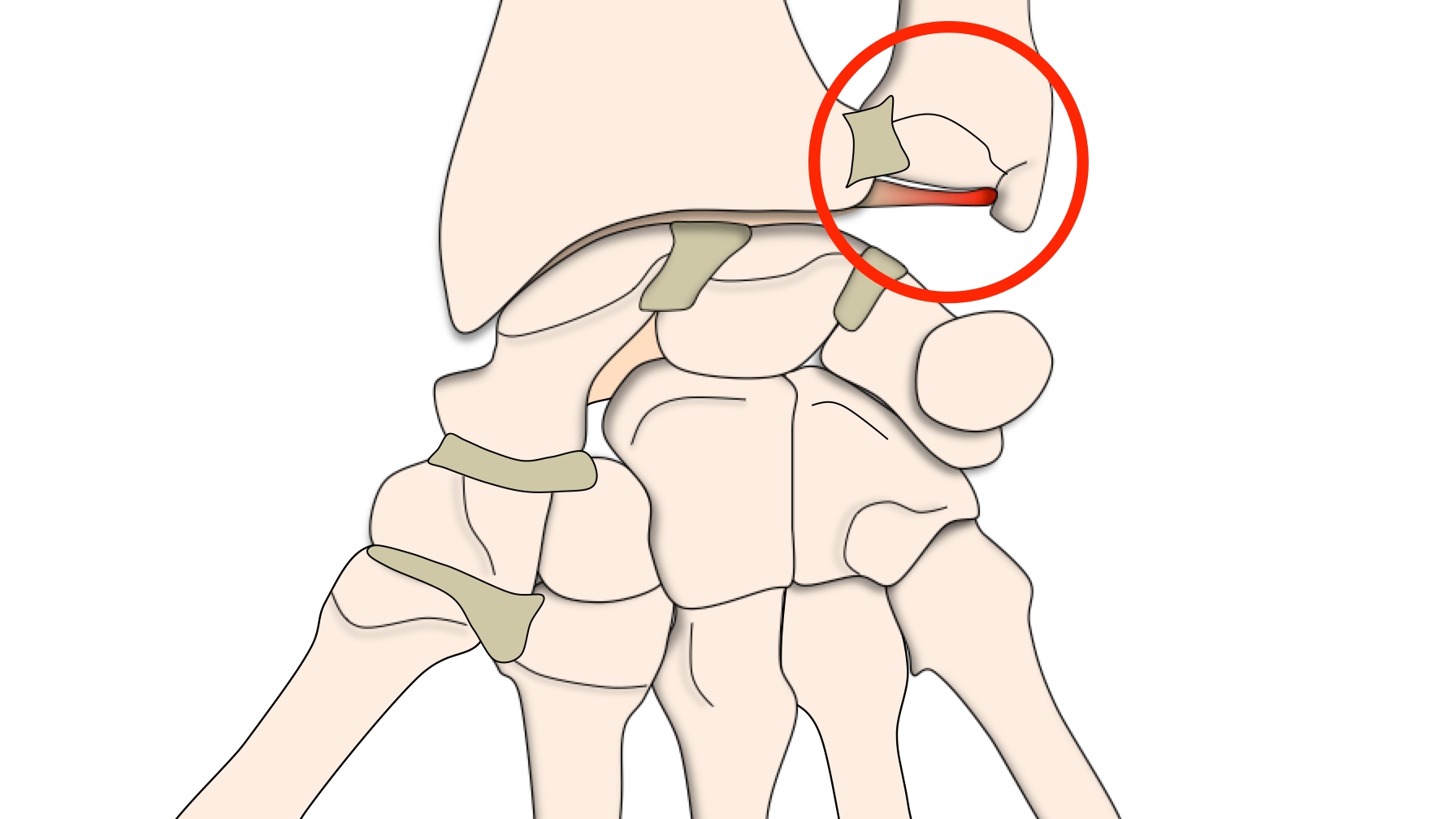 Entorses du / Lésions ligamentaires Clinique Ostéo